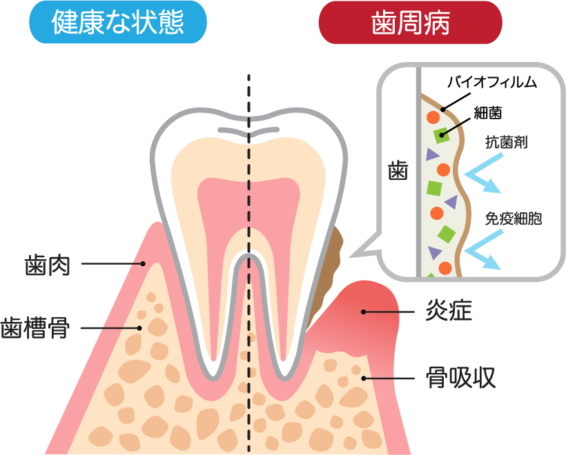 歯周病