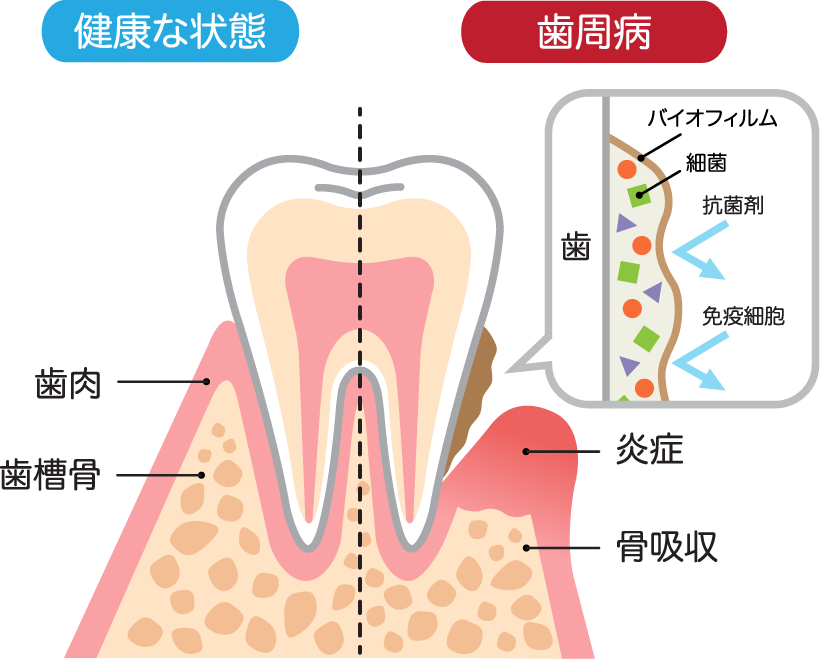 歯周病